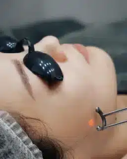 Pico laser image for acne scar laser treatment and pigmentation care in Singapore for Korean skin management in Singapore