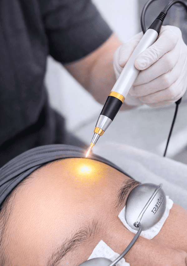 Yellow laser treatment in Singapore helps brighten the complexion, calm redness and support a healthier-looking skin glow