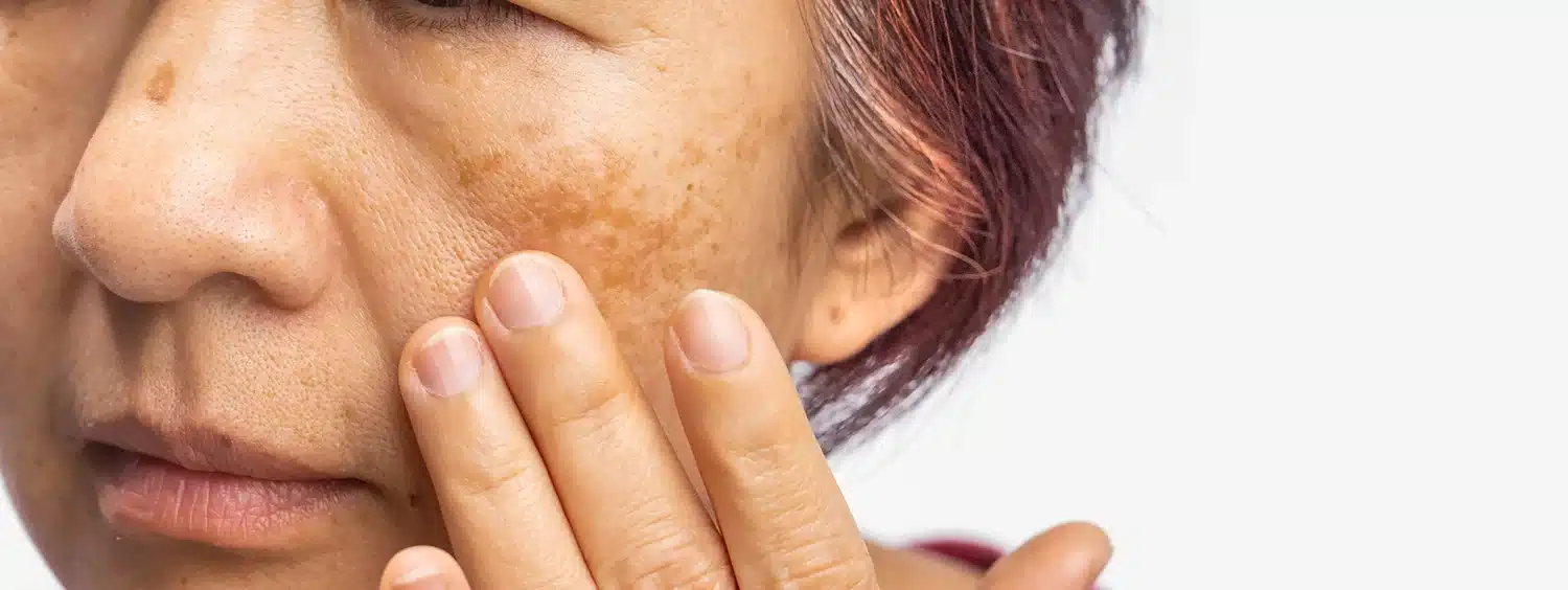 Not all brown patches on Asian skin are the same. Melasma, PIH, sunspots, and Hori's naevus each have a different cause, depth, and treatment requirement