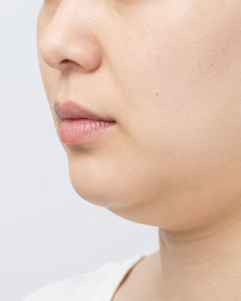 Side profile of the chin and jawline showing submental fullness before double chin treatment in Singapore