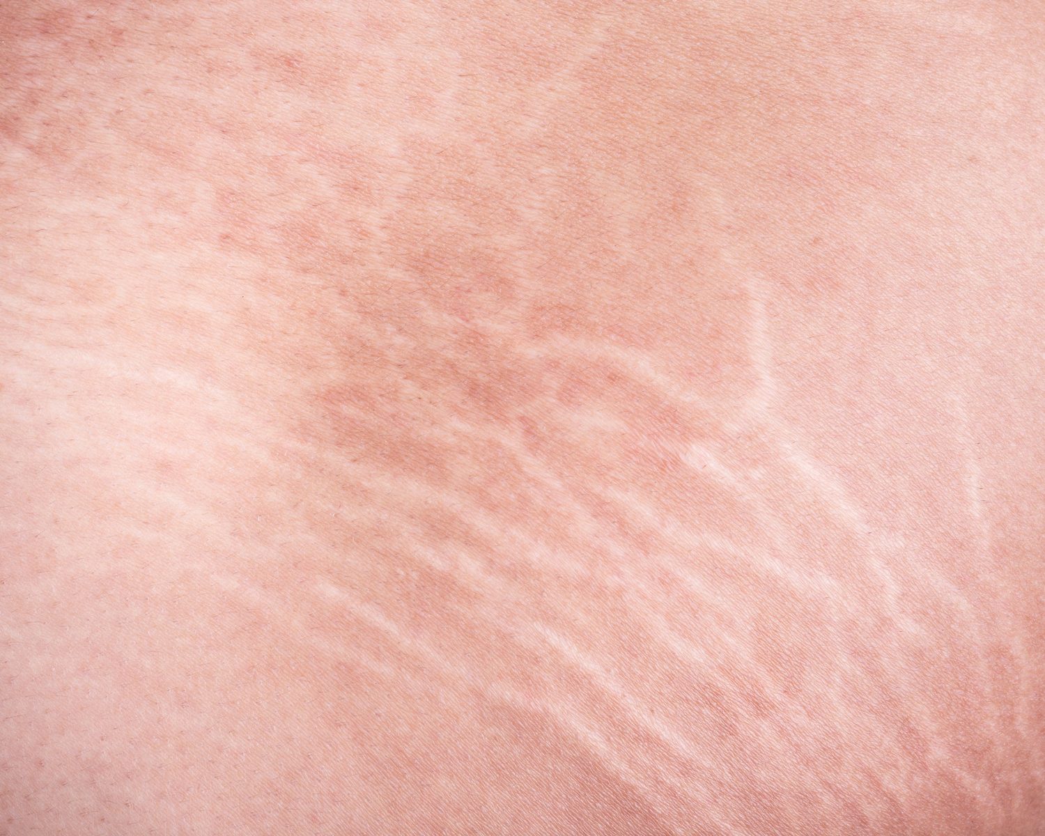 Close-up of stretch marks on the skin, a common concern for stretch mark removal in Singapore